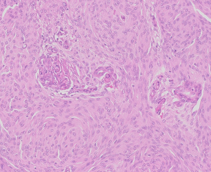 Mengioma_ vascular changes and prognosis
