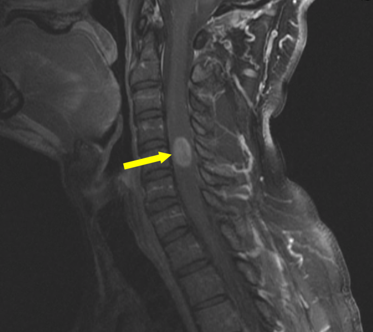 spinal ependymoma typical radiographic appearance